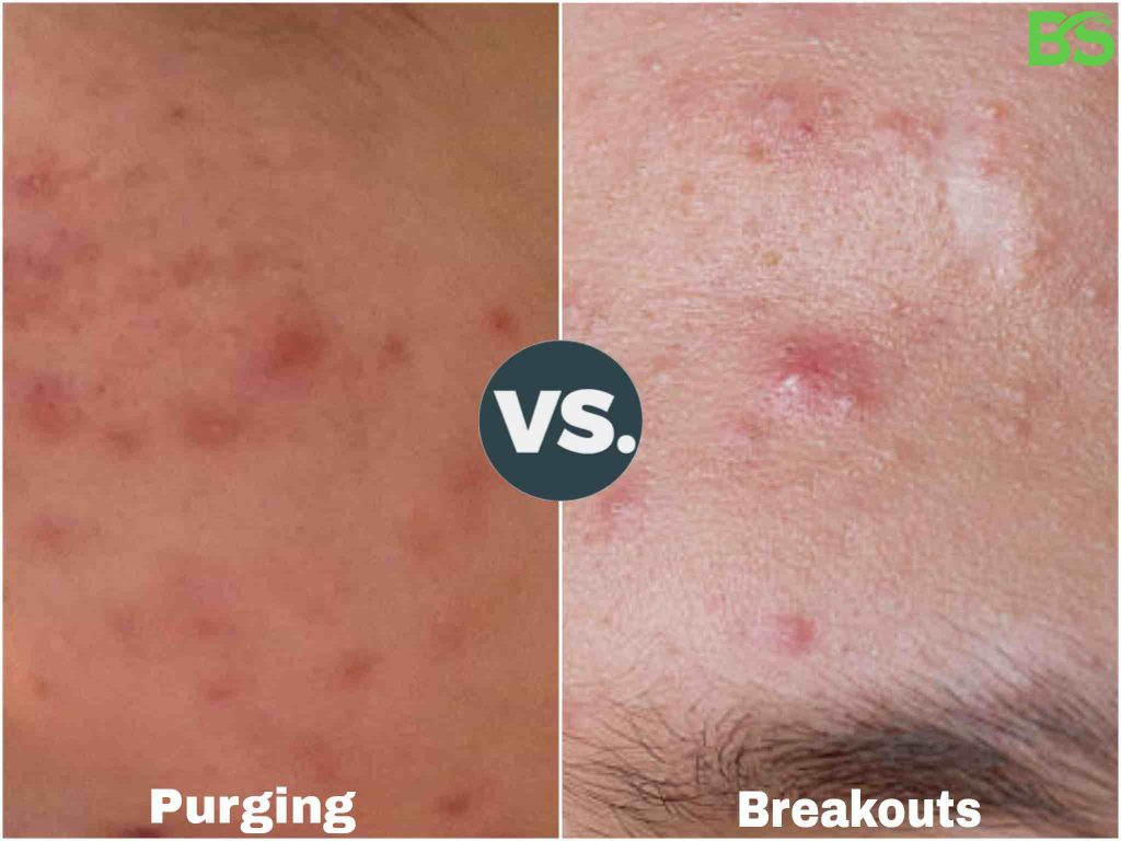Skin Purging Or Breaking Out? - How To Tell The Difference -  BeautySparkReview