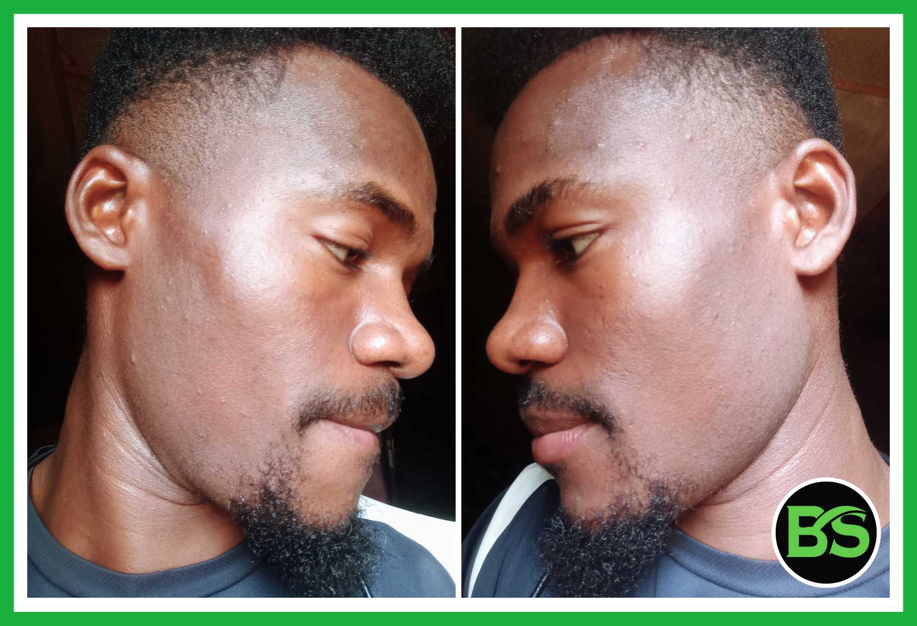 Minoxidil For Beard, Minoxidil For Hair, before and after 