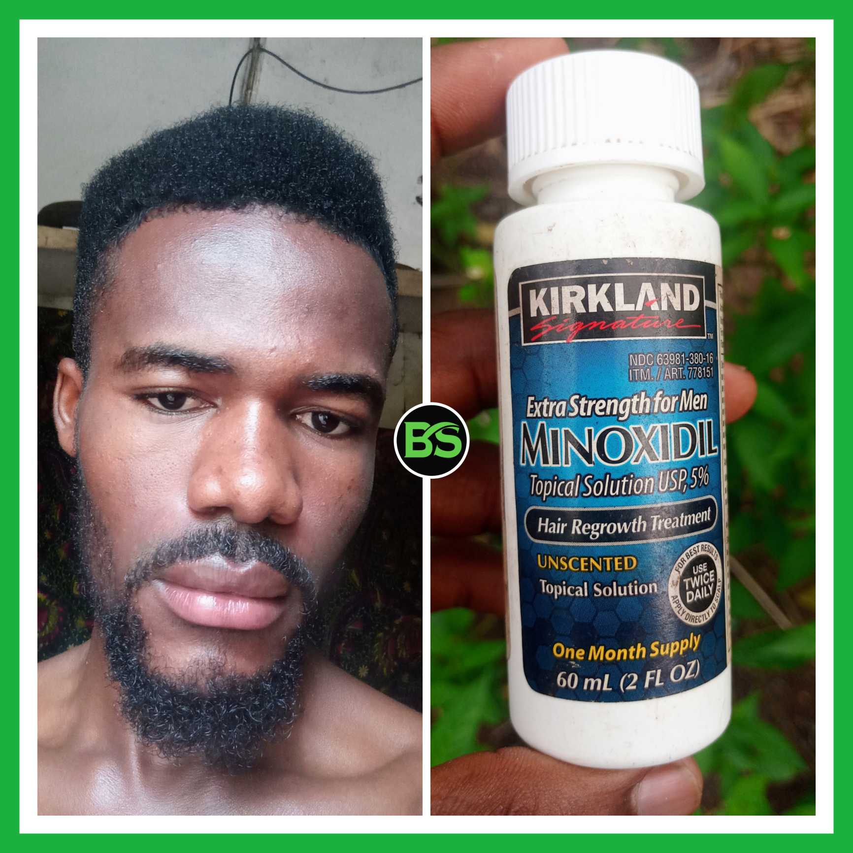 Minoxidil For Beard & Hair Growth - I Used Minoxidil To Grow My Beard From  Nothing (And Hair Corners Too) - BeautySparkReview