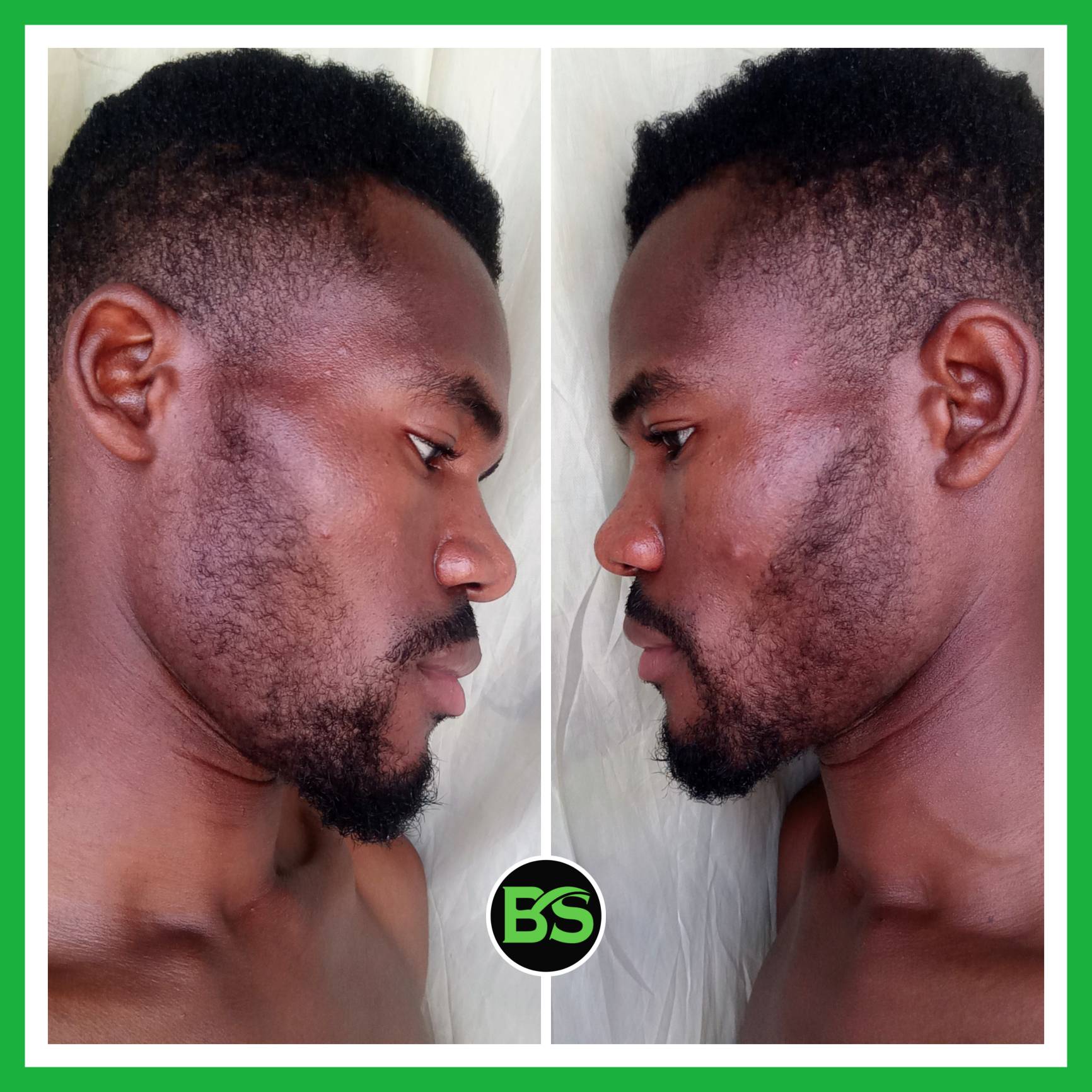 Minoxidil for beard growth. Before and after 